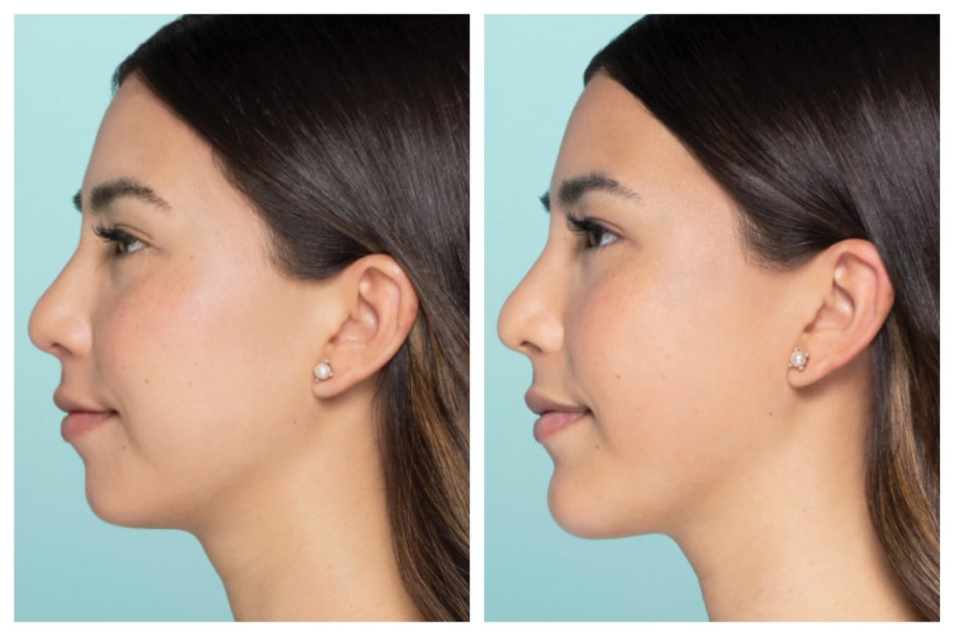 Restylane Before and After – Restore Volume Naturally